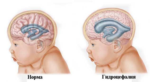 гидроцефалия у детей