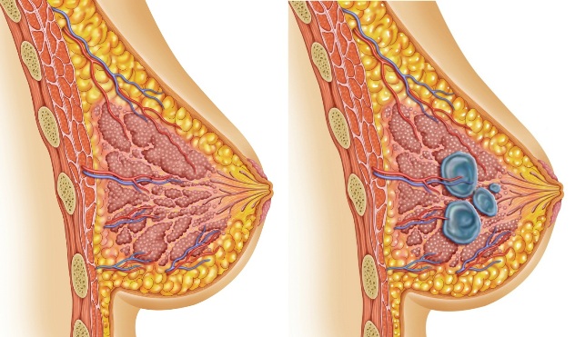 фиброзная мастопатия 