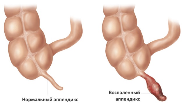 аппендицит у детей