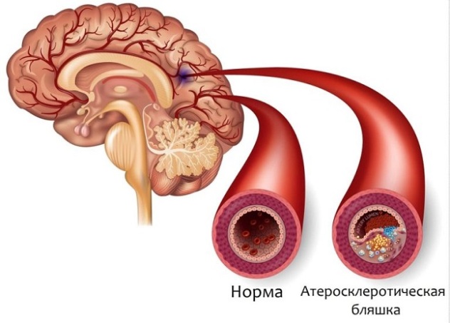 причиной постоянной сонливости может быть атеросклероз церебральных сосудов