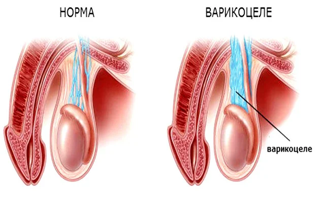 варикоцеле у мужчин - причина не наступления беременности, если есть овуляция
