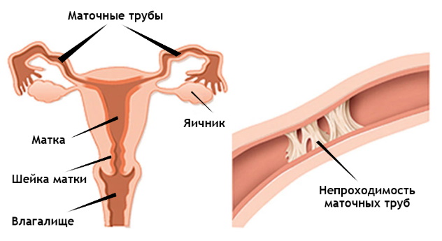 непроходимость маточных труб – причина по которой беременность не наступает с овуляцией
