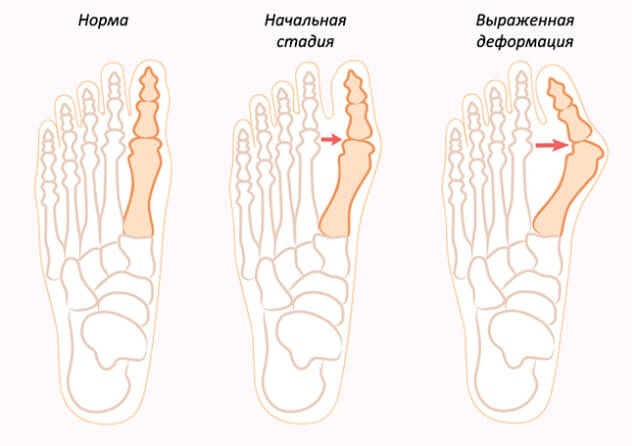 Стадии вальгусной деформации